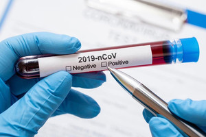 Лабораторно підтверджено коронавірус у жителя міста Носівка